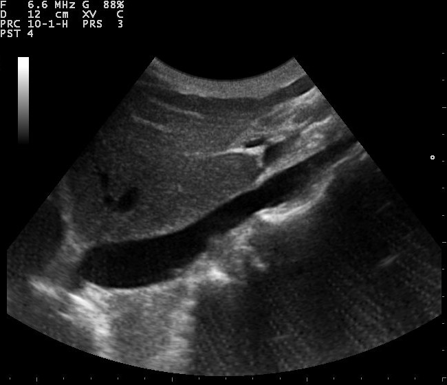 IVC Ultrasound image